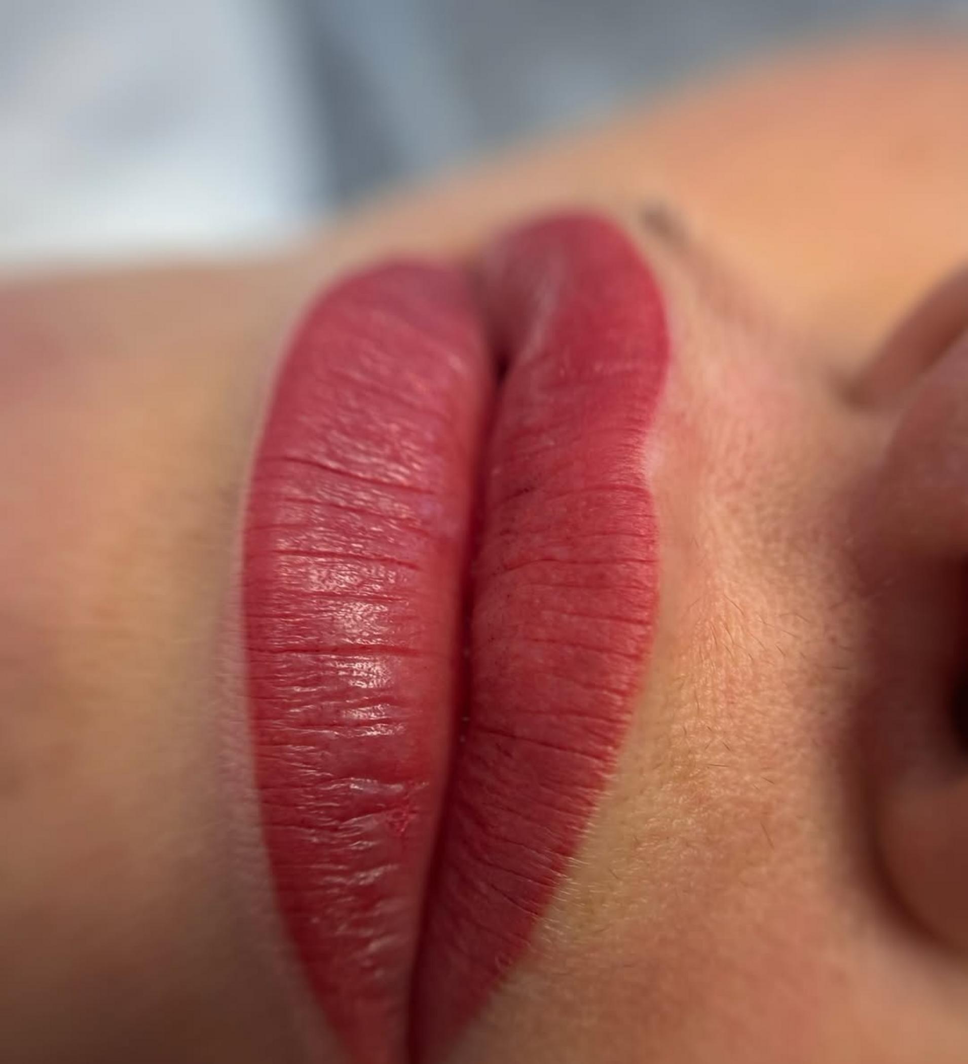 before and after lip filler results